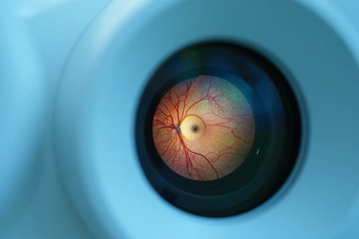 Examen ophtalmologique du nerf optique — illustration article sur sémaglutide et NAION