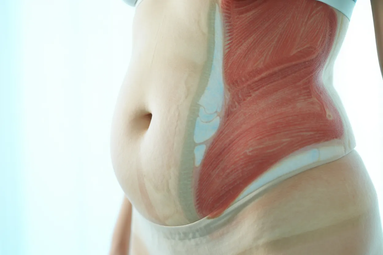 Analyse de composition corporelle montrant la réduction de masse grasse sous traitements GLP-1